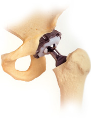 protesis de cadera