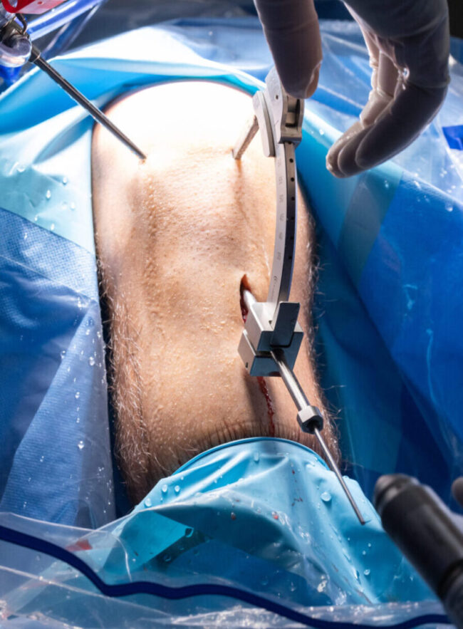 Cirugía de ligamento cruzado anterior rodilla
