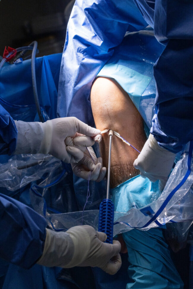 Artroscopia de rodilla en Madrid con cámara diminuta para observar la rodilla