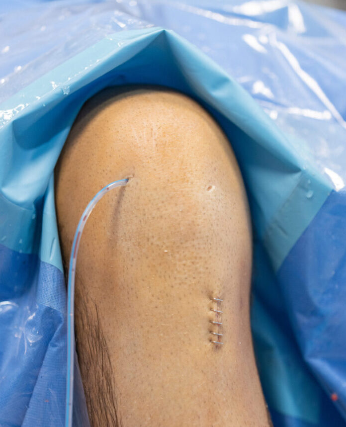 Artroscopia de rodilla, es una pequeña cámara en la rodilla