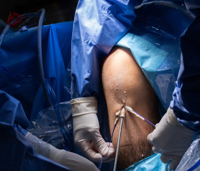 rotura de ligamento cruzado anterior de rodilla en Madrid clínica IMTRA