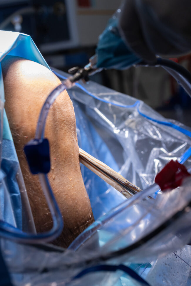 Artroscopia de rodilla en rodilla IMTRA